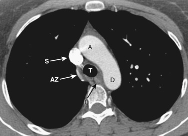 FIG 38-4, Axial plane—arch of the azygos vein or aortopulmonary window level. The azygos vein (AZ) arches from a posterior position along the midesophagus to join the superior vena cava (S), crossing over the right upper lobe bronchus. Between the ascending (A) and descending (D) aorta is the aortopulmonary window region. E, esophagus; T, trachea.