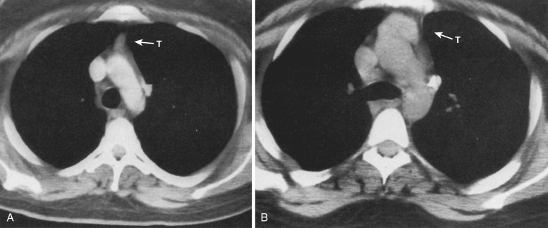 FIG 38-41, Thymic rebound. A, CT at the time of chemotherapy shows thymus (T) is small. B, CT after cessation of chemotherapy shows thymus (T) has increased in size.