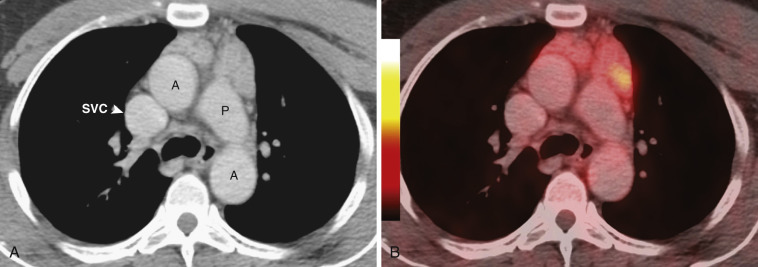 FIG 38-42, Thymic hyperplasia in a young patient with chest pain. A, Contrast-enhanced CT demonstrates a prominent thymus without a discrete mass. A, aorta; P, pulmonary artery; SVC, superior vena cava. B, PET/CT shows homogeneous FDG uptake within the thymus.