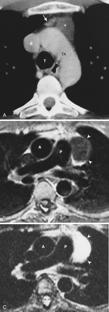 FIG 38-43, Congenital thymic cyst. A, Contrast CT shows a homogeneous water-attenuation cyst (asterisk) in the anterior mediastinum. Note absence of perceptible walls and a residual right thymic lobe (arrow). S, superior vena cava; T, trachea; TA, transverse aorta. B and C, MRIs obtained more caudally show that the mass (arrowheads) is homogeneous and of low signal intensity on the T1-weighted image ( B ) and of high signal intensity on the T2-weighted image ( C ). This appearance is typical of a cyst. A, ascending aorta; P, main pulmonary artery.
