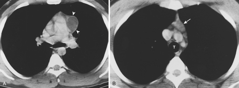 FIG 38-44, Seminoma associated with a thymic cyst. A, Contrast CT shows a well-circumscribed water-attenuation mass in the anterior mediastinum. Note the thin but perceptible wall (arrowheads). B, A more cephalic image reveals the soft tissue component of the mass (arrow). Resection revealed seminoma. T, trachea.