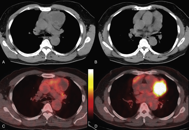 FIG 38-45, Acquired multilocular thymic cyst in an asymptomatic 64-year-old man who presented with an anterior mediastinal mass noted on a preoperative chest radiograph. A and B, Axial CT images demonstrate a complex multicystic mass in the anterior mediastinum. C and D, Axial PET/CT shows increased FDG uptake within the cyst walls.