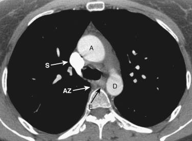 FIG 38-5, Axial plane—aortopulmonary window level. The aortopulmonary window is between the ascending (A) and descending (D) aorta and the superior vena cava (S). AZ, azygos vein; E, esophagus.