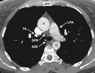 FIG 38-6, Axial plane—left pulmonary artery level. To the left of the left pulmonary artery (LPA) lie the left superior pulmonary veins. The ascending (A) and descending (D) aorta and superior vena cava maintain their relative positions from the level above. The truncus anterior (TA), or right upper lobe pulmonary artery, is anterior to the right upper lobe bronchus. The azygoesophageal recess (AZE) is a concavity anterior to the spine. The superior pericardial recess (SPR) is an extension of the pericardium.