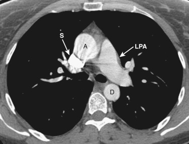 FIG 38-7, Axial plane—left pulmonary artery level. A, ascending aorta; D, descending aorta; LPA, left pulmonary artery; S, superior vena cava.