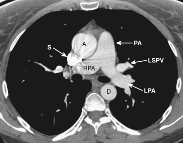 FIG 38-8, Axial plane—right pulmonary artery level. The main pulmonary artery (PA) divides into the left (LPA) and right (RPA) pulmonary arteries. The right pulmonary artery passes anterior to the right main bronchus, and the left pulmonary artery passes over the left main bronchus. A, ascending aorta; D, descending aorta; LSPV, left superior pulmonary vein; S, superior vena cava.