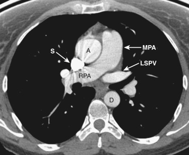 FIG 38-9, Axial plane—right pulmonary artery level. The main pulmonary artery (MPA) divides into the right pulmonary artery (RPA) and the left pulmonary artery, which is more superior and not visible. The left superior pulmonary vein (LSPV) is anterior to the left main bronchus, and the left pulmonary artery is posterior. A, ascending aorta; D, descending aorta; S, superior vena cava.