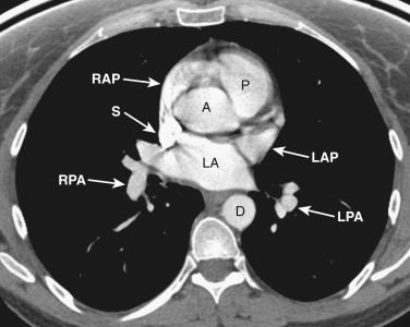 FIG 38-10, Axial plane—left atrial level. The left atrium (LA) is the most superior and posterior chamber of the heart. Superior pulmonary veins enter the anterosuperior portion of the left atrium. The left atrial appendage (LAP) is situated anterior and to the left of the left atrium, adjacent to the main pulmonary artery (P). The right atrial appendage (RAP) is anterior to the superior vena cava (S) and adjacent to the ascending aorta (A). D, descending aorta; LPA, left pulmonary artery; RPA, right pulmonary artery.