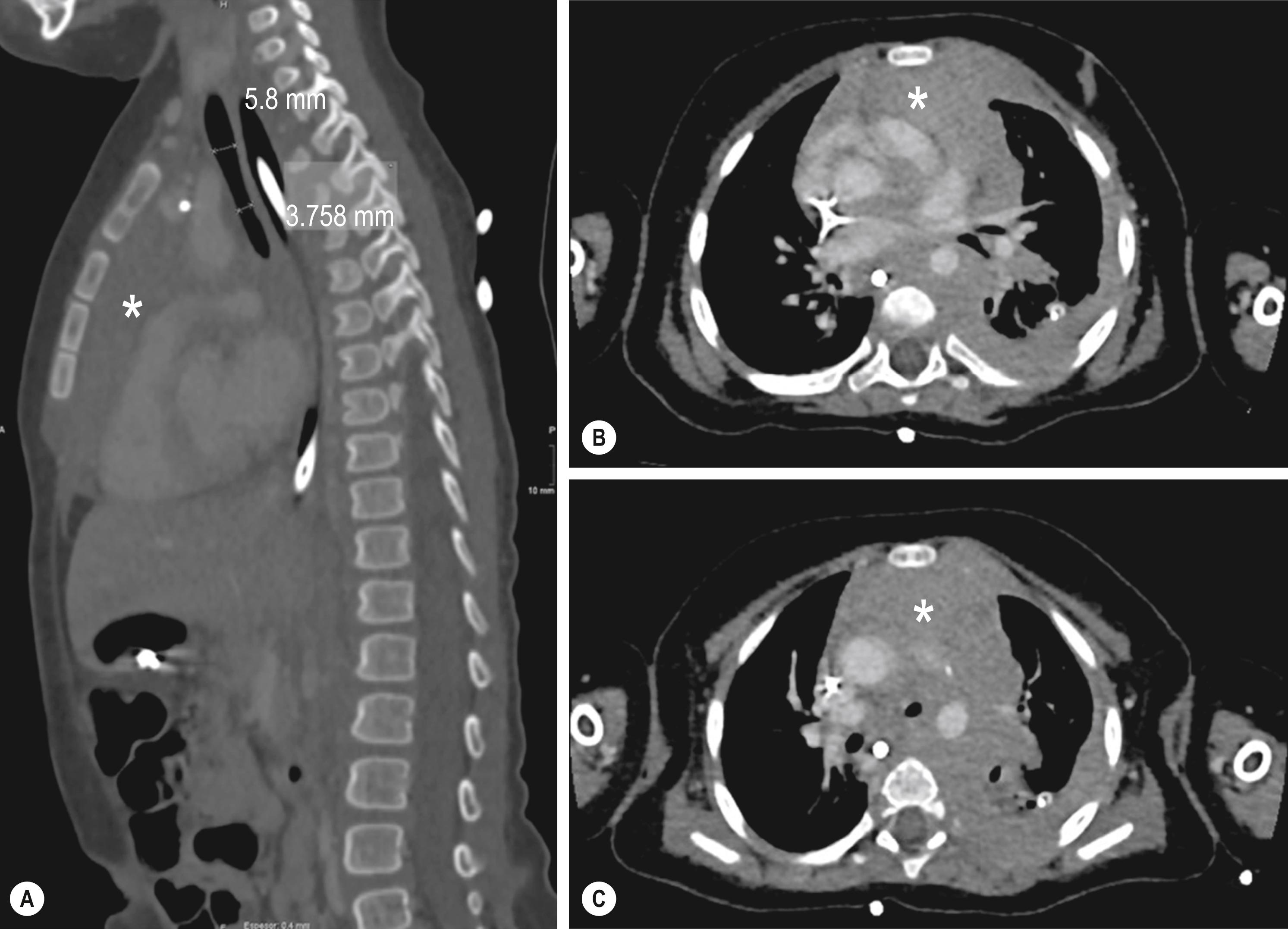 Fig. 25.2, Sagittal (A) and axial (B, C) contrast-enhanced CT images of a 7-year-old girl with a T-cell NHL. Cardiac insufficiency, superior vena cava syndrome, and severe dyspnea were the initial symptoms. The CT scan depicts a large mediastinal mass (asterisks) and a significant pericardial and pleural effusion. Diagnosis was made by cytometry analysis from the pericardial fluid.