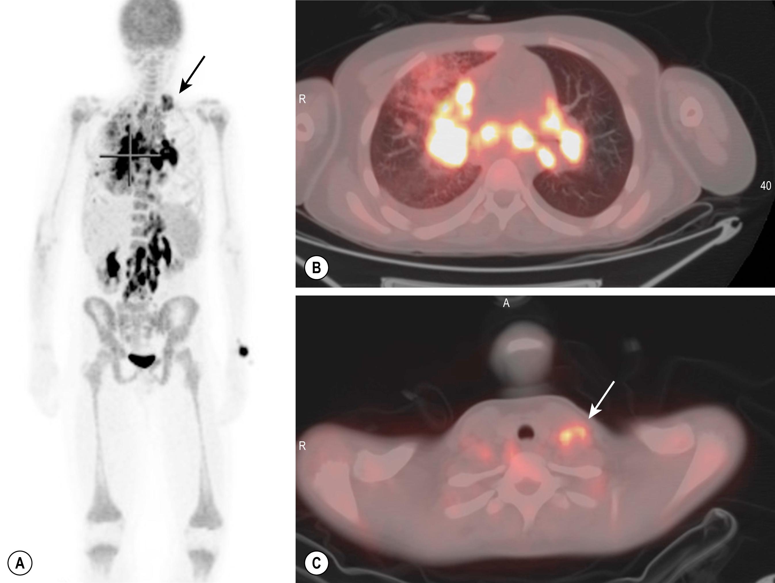 Fig. 25.3, 18 FDG PET (A) and PET/CT scan (B, C) of a 10-year-old boy with an anaplastic large-cell NHL. Extensive mediastinal and abdominal FDG uptake in the lymphoma is clearly seen. A biopsy was performed in the left cervical region ( arrows, A, C) , avoiding a more risky procedure in the thorax or the abdomen.