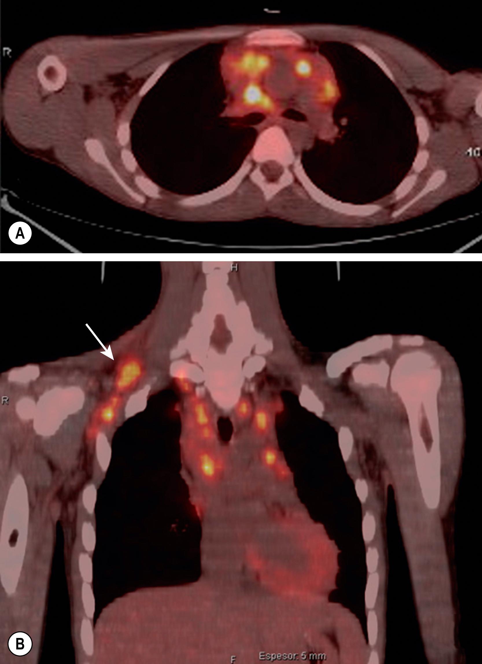 Fig. 25.4, 18 FDG PET/CT and PET axial (A) and coronal (B) images of a 9-year-old girl with nodular-sclerosis Hodgkin lymphoma. Mediastinal involvement was not too extensive, but there was increased FDG uptake in some nodes in the right supraclavicular area (arrow) where the biopsy was taken.