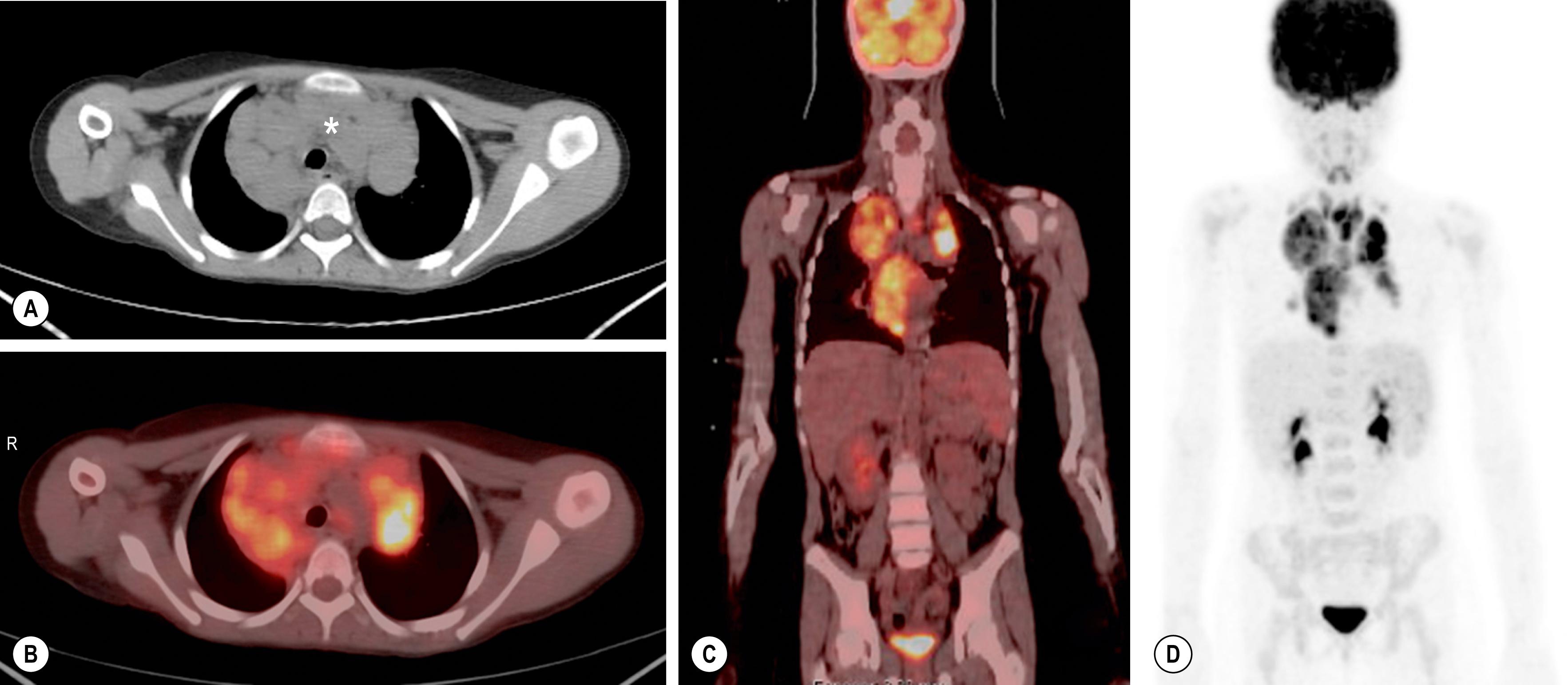 Fig. 25.5, Axial CT (A) and PET-CT (B) of a 10-year-old girl with mediastinal nodular-sclerosis Hodgkin lymphoma (asterisk). Coronal PET-CT (C) and PET (D) scans do not show pathologic activity in the cervical nodes. The diagnosis was made by biopsy via thoracoscopy.