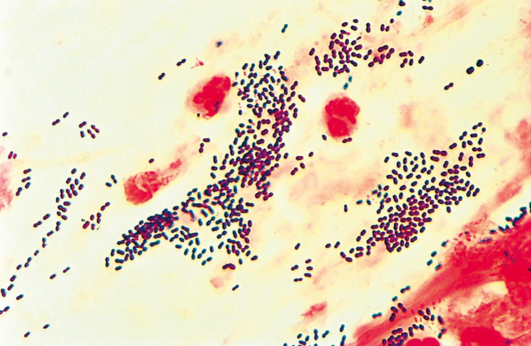 Figure 57.1, Gram stain of a sputum smear shows neutrophils, debris, and gram-positive diplococci, suggestive of pneumococcal infection (oil immersion).