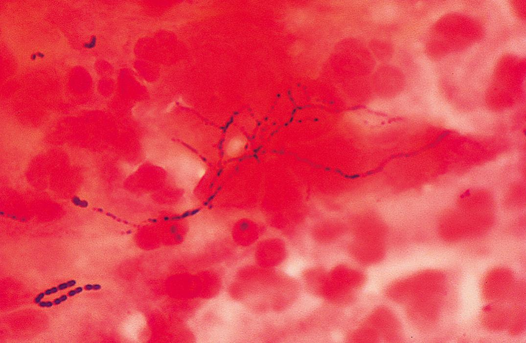 Figure 57.11, Sputum smear stained with Gram stain shows neutrophils, amorphous debris, and filamentous, beaded, branched gram-positive bacilli (oil immersion).