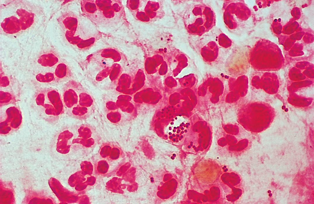 Figure 57.12, Sputum smear stained with Gram stain shows many neutrophils and intracellular gram-negative diplococci, suggestive of Neisseria meningitidis infection (oil immersion).