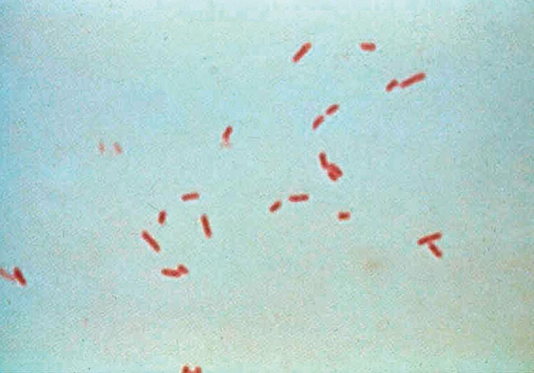 Figure 57.14, Gram stain of urine positive for Escherichia coli . The short, plump gram-negative rods are typical of any member of the Enterobacterales (oil immersion).