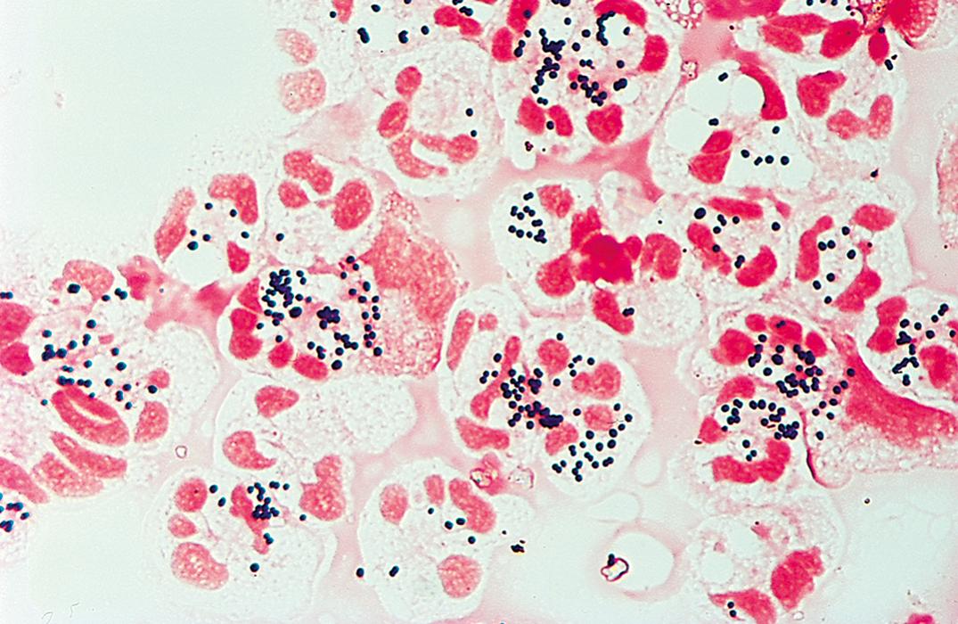 Figure 57.2, Cytocentrifuge preparation of cerebrospinal fluid stained with Gram stain shows many neutrophils, smooth amorphous material, and gram-positive cocci in pairs, short chains, and clusters, suggestive of staphylococcal infection (oil immersion).