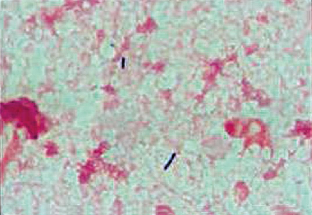 Figure 57.9, Gram stain of Bacillus cereus in pleural fluid (oil immersion).