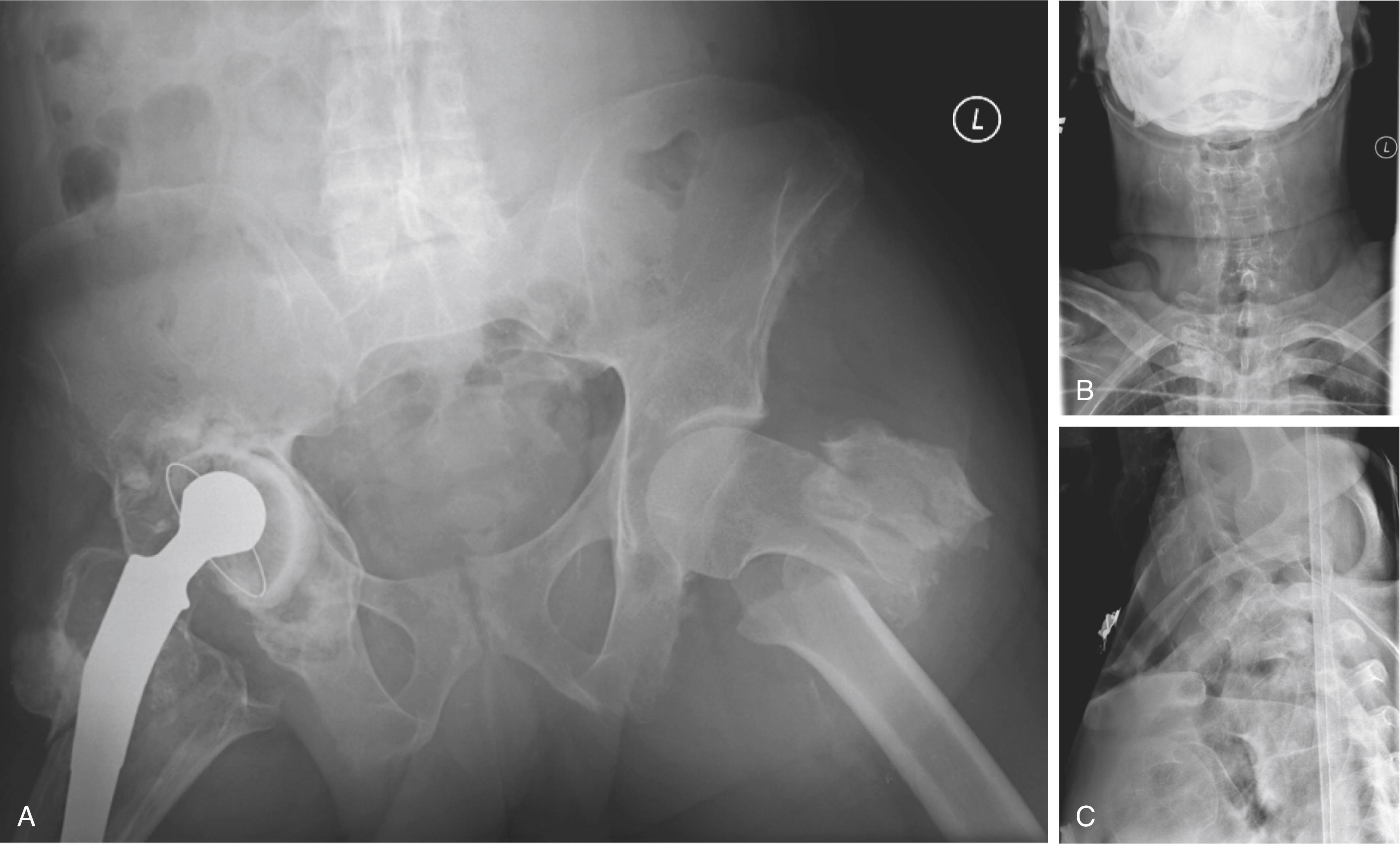 Fig. 164.1, Initial imaging of a 53-year-old male involved in a motor vehicle accident with bilateral hip pain who was neurologically intact and had no complaints of neck or arm pain. ( A ) Anteroposterior (AP) radiograph of the pelvis demonstrating bilateral proximal femur fractures. AP ( B ) and lateral ( C ) radiographs of the cervical spine showing an extension-distraction injury at C6‒C7 in the same patient.