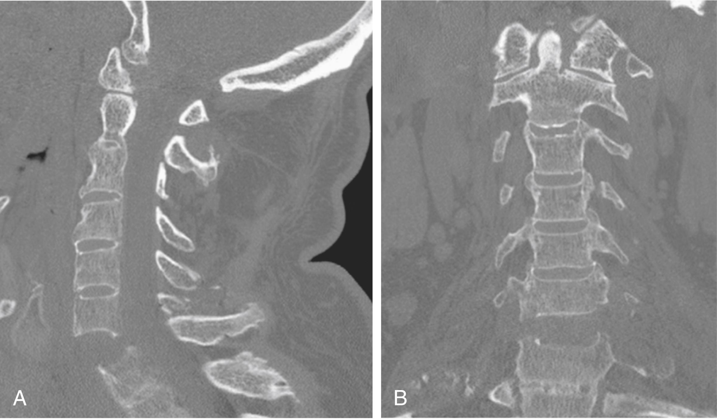 Fig. 164.2, Further imaging of the cervical spine in the same patient as in Fig. 164.1 . Sagittal ( A ) and coronal ( B ) computed tomography images demonstrating the ankylosed cervical spine and injury at C6‒C7.