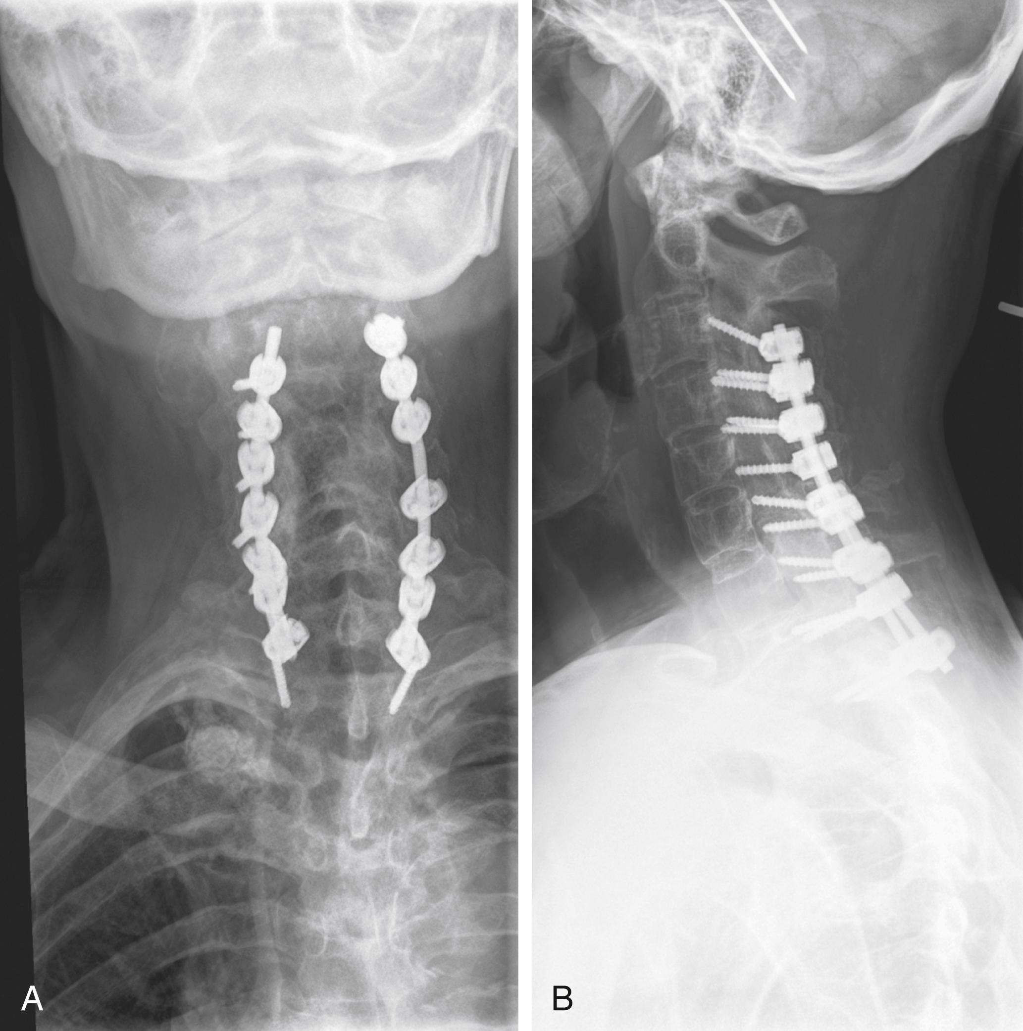 Fig. 164.3, The same patient as in Fig. 164.1 was taken emergently for open reduction and internal fixation of the cervical spine fracture. Anteroposterior ( A ) and lateral ( B ) radiographs at the 1-year follow-up after posterior spinal fusion.