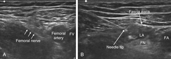 Fig. 76.11, A, View of the ultrasound anatomy in the femoral crease. The femoral nerve (FN) appears as a tear-shaped structure lateral to the femoral artery and vein (FV). The fascia lata and iliaca lie superior to the nerve. B, An in-plane approach to the FN allows for direct visualization of the block needle. In this image, local anesthetic (LA) can be seen surrounding the FN. The local anesthetic stays confined to an area below the fascia iliaca and fascia lata. FA, Femoral artery.