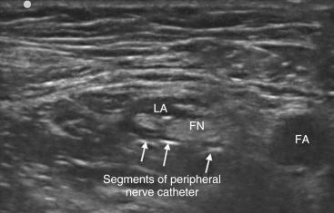 Fig. 76.12, Continuous femoral nerve catheter. In this view, a catheter that has been placed appears as bright, hyperechoic structure lying posterior to the femoral nerve (FN). Local anesthetic that has been injected through the catheter can be seen surrounding the nerve. FA, Femoral artery; LA, local anesthetic.