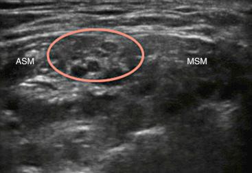 Fig. 76.4, Ultrasound image of the interscalene groove. At this level, the roots and trunks of the brachial plexus can be identified as hypoechoic structures (circle) lying between the anterior scalene muscle (ASM) and middle scalene muscle (MSM).