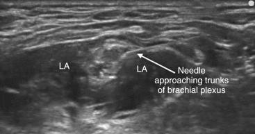 Fig. 76.5, An in-plane approach allows for direct visualization of the block needle as it approaches the trunks of the brachial plexus within the interscalene groove. The local anesthetic (LA) is hypoechoic on ultrasonography and can be seen spreading in a circumferential fashion around the nerve structures.