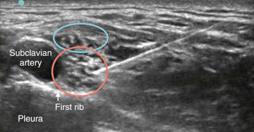 Fig. 76.6, The ultrasound probe placed in the supraclavicular fossa allows for quick identification of the brachial plexus. Above both the upper (blue circle) and lower trunks (red circle) of the brachial plexus can be easily identified. In this view, the nerve structures are hypoechoic and appear as a cluster of grapes lying superiorly and laterally to the subclavian artery. This view demonstrates that before entering the axilla, most of the nerve structures of the upper extremity lie within close proximity to each other. This allows for a single-site injection that produces anesthesia and analgesia for most of the upper extremity.