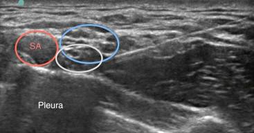 Fig. 76.7, An ultrasound-guided supraclavicular block using an in-plane technique. With the upper (blue circle) and lower (gray circle) trunks easily identified, the needle is directed toward the 5 o'clock position of the subclavian artery (SA). The initial spread of local anesthetic in this picture can be seen around the lower trunk. As the injection continues, local anesthetic will continue to surround the trunks, allowing for anesthesia and analgesia of most of the upper extremity.
