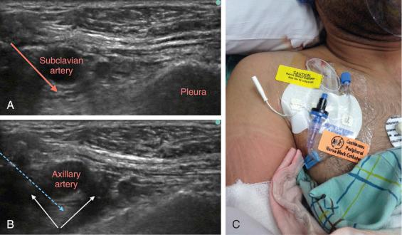 Fig. 76.8, A, The infraclavicular approach to the brachial plexus allows for blockade of the brachial plexus at the level of the cords. In this view, the cords appear as small, densely hyperechoic structures lying lateral, posterior, and medial to the axillary artery. The arrow signifies the desired trajectory of the block needle. B, With the needle placed at the 6 o'clock position, the axillary artery injection allows for circumferential spread about the artery. Spread in this distribution allows for blockade of all three cords without further manipulation of the block needle. C, Example of a continuous infraclavicular catheter that has been secured to the chest wall. Catheter placement at this location is less likely to migrate or dislodge than other sites (axillary) and is comfortable for the patient.