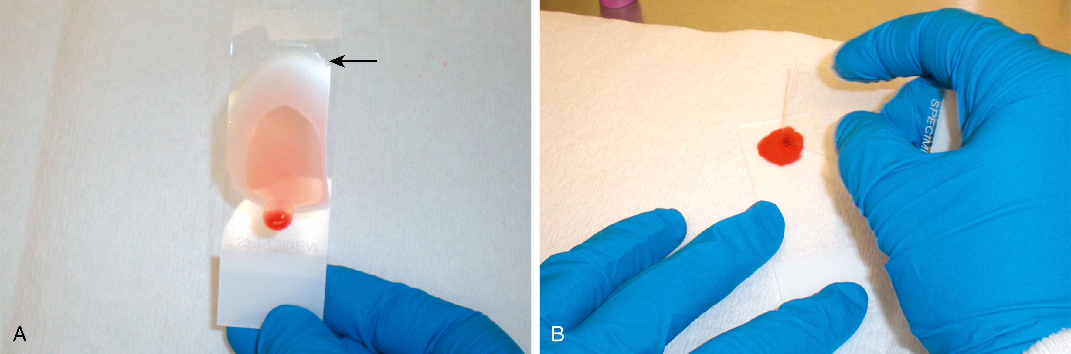 Figure 65.1, A, Thin blood film demonstrating a broad feathered edge (arrow) . B, Preparation of a thick blood film. Gentle pressure is used to create minute scratches in the carrier slide while spreading the blood into a 1.5- to 2.0-cm diameter film with the spreader slide. This method improves the adherence of the thick film to the carrier slide and prevents it from detaching during staining.