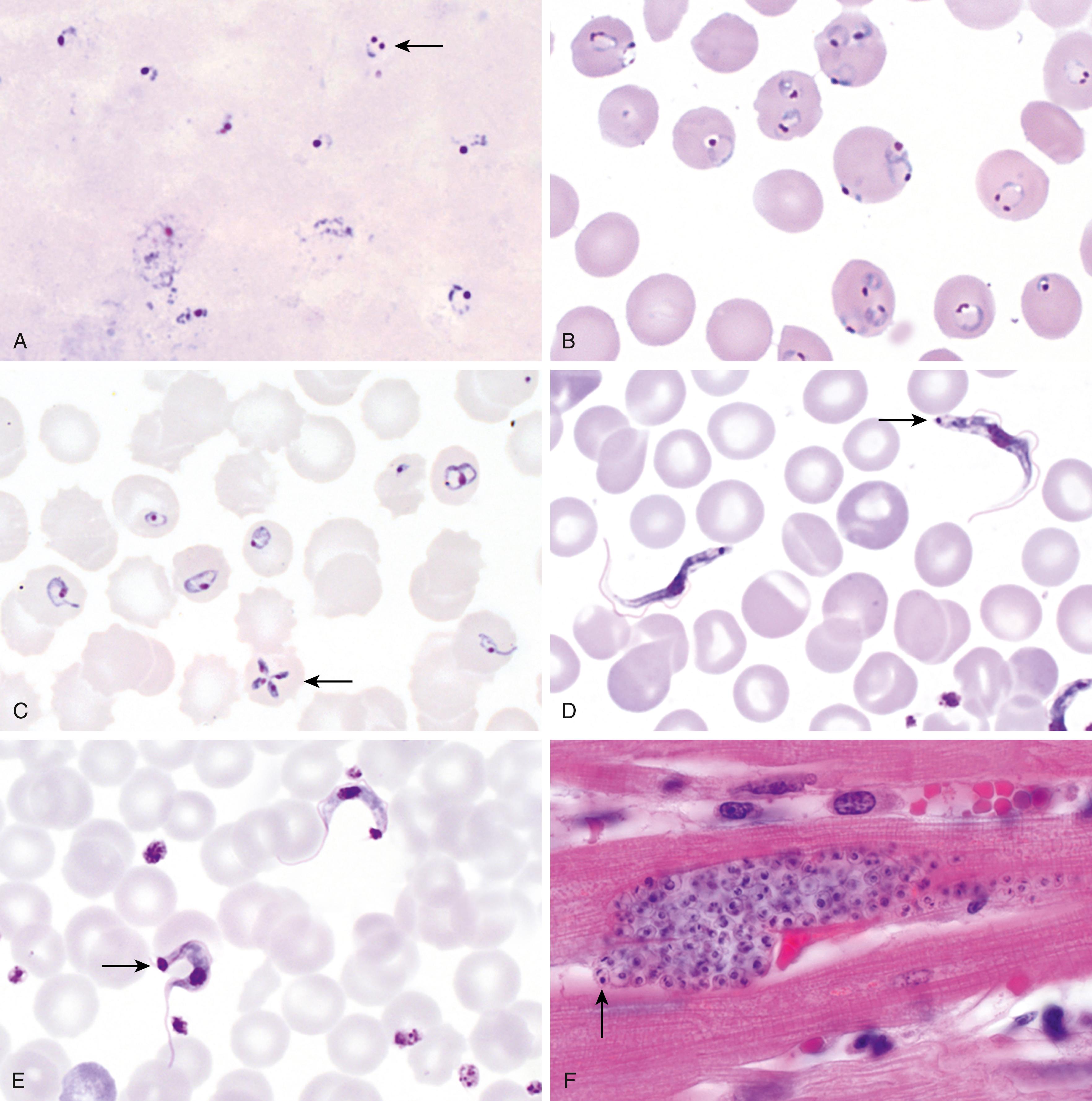 Figure 65.6, A, Plasmodium falciparum in Giemsa-stained thick blood film showing thin, delicate rings and a “headphone” form (arrow) (1000×). B, Plasmodium falciparum in Giemsa-stained thin blood film; note high parasitemia, multiply infected red blood cells, and delicate ring forms with appliqué and headphone forms (1000×). C, Babesia microti in Giemsa-stained thin blood film; note high parasitemia, multiply infected red blood cells with irregular forms, and Maltese cross configuration (arrow) (1000×). D, Trypanosoma brucei in thin blood film; note nucleus, small kinetoplast (arrow) , anterior flagellum, and undulating membrane (Giemsa stain; 1000×). E, Trypanosoma cruzi in thin blood film; note nucleus, large kinetoplast (arrow) , anterior flagellum, and undulating membrane (Giemsa stain; 1000×). F, Trypanosoma cruzi amastigotes in a cardiac biopsy; individual amastigotes with a small nucleus and rod-shaped kinetoplast (arrow) are visible (hematoxylin and eosin [H&E], 1000×). G, Leishmania sp. amastigotes in an impression smear of lymph node (Giemsa stain; 1000×). H, Pseudocyst (left) and free tachyzoites (arrows) of Toxoplasma gondii in brain tissue (H&E; 1000×). I, Intracellular and free T. gondii tachyzoites in an impression smear of brain tissue from an immunocompromised patient with reactivated disease (Giemsa; 1000×).