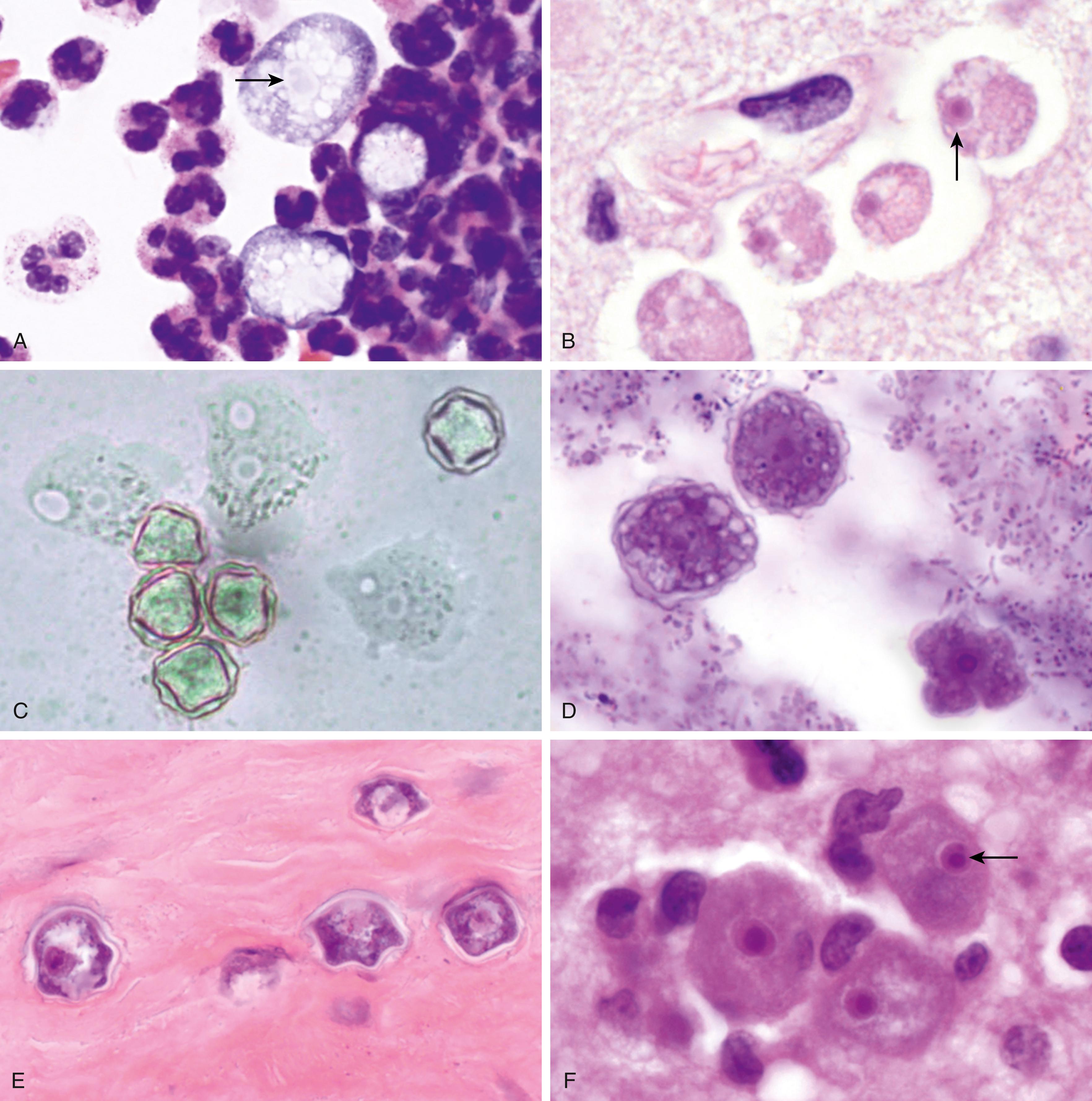 Figure 65.8, A, Naegleria fowleri trophozoites in the cerebrospinal fluid in a case of primary amebic meningoencephalitis (PAM). Note the pale nucleus with large karyosome (arrow) (Giemsa; 1000×). B, Naegleria fowleri trophozoites in an H&E-stained brain section in a case of PAM; note the small nucleus with large central karyosome (arrow) (1000×). C, Acanthamoeba sp. trophozoites and cysts on an agar culture (1000×). D, Acanthamoeba sp. cysts (left) and trophozoite (right) in contact lens fluid in a case of acanthamebic keratitis. There are abundant bacteria also present (H&E; 1000×). E, Double-walled cysts of Acanthamoeba sp. within corneal stroma (H&E; 1000×). F, Trophozoites in brain tissue in a case of Balamuthia mandrillaris granulomatous amebic encephalitis. The small nucleus with central large karyosome is highlighted (arrow) (H&E; 400×).