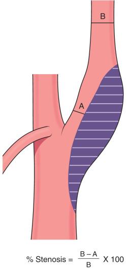 Figure 15.1, NASCET criteria for grading carotid artery stenosis.