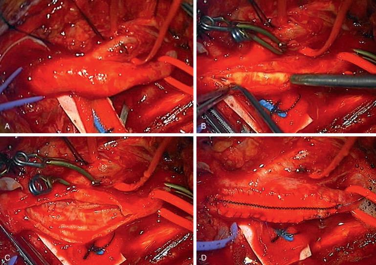 Figure 15.2, Carotid endarterectomy. The common carotid artery (CCA), internal carotid artery (ICA), and external carotid artery (ECA) are exposed (A). A linear arteriotomy is made extending from the CCA to the distal ICA beyond the atherosclerotic plaque, and the plaque is dissected from the arterial wall (B). Plaque dissection is completed and the arterial wall is inspected for intimal injury (C). Closure is performed with a patch graft (D).