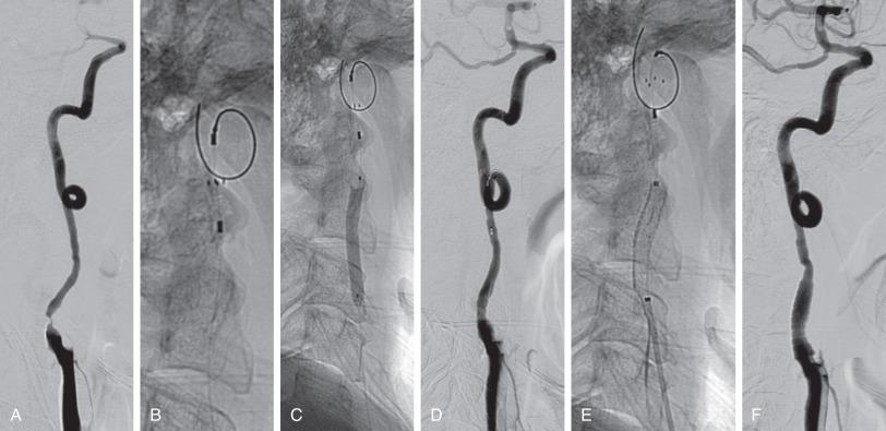 Figure 15.3, Carotid artery stenting. Angiography of the CCA demonstrates severe stenosis of ICA with flow limitation and occlusion of the ECA ( lateral view, A). Magnified view of the deployment of this distal embolic protection device (B). Angioplasty with a noncompliant balloon is performed prior to stent placement (C) with improvement in stenosis and distal flow (D). The stent is deployed (E) with improvement in ICA stenosis and distal flow (F).