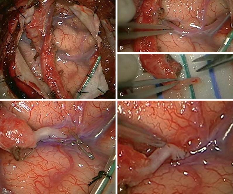 Figure 15.4, Direct revascularization with superficial temporal artery to middle cerebral artery (STA-MCA) bypass. The craniotomy and dural opening have been performed, and the STA and cuff of tissue are displayed across the surgical field (A). The recipient artery is dissected from the surrounding arachnoid (B). The STA is prepared by removing adventitia and making an angled cut in the distal end, which is fish-mouthed open to lengthen to arteriotomy (C). The “heel” and “toe” stitches of the end-to-side anastomosis have been completed (D). The anastomosis has been completed with interrupted suture, and temporary clips have been removed (E).