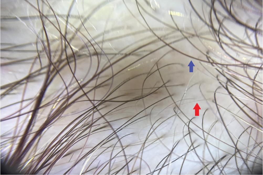 Fig. 1.3, Dermoscopic Examination of the Scalp of an Individual With Androgenetic Alopecia.