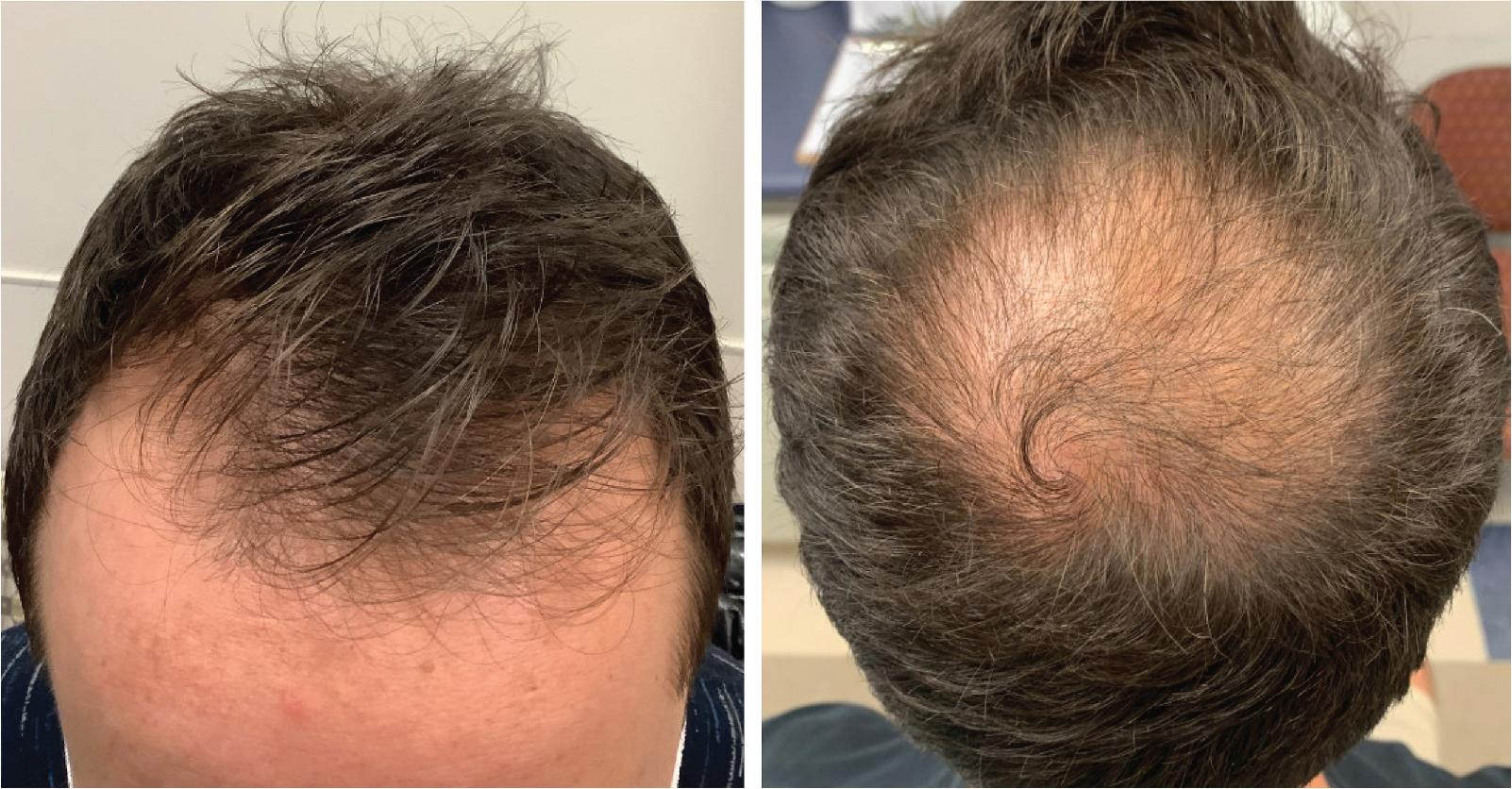 Fig. 1.4, Male Pattern Hair Loss.