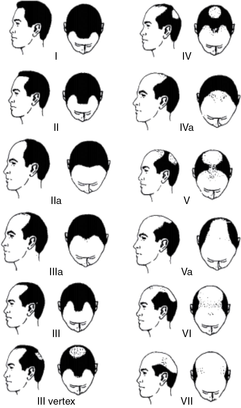 Fig. 1.5, Hamilton-Norwood Pattern of Hair Loss.