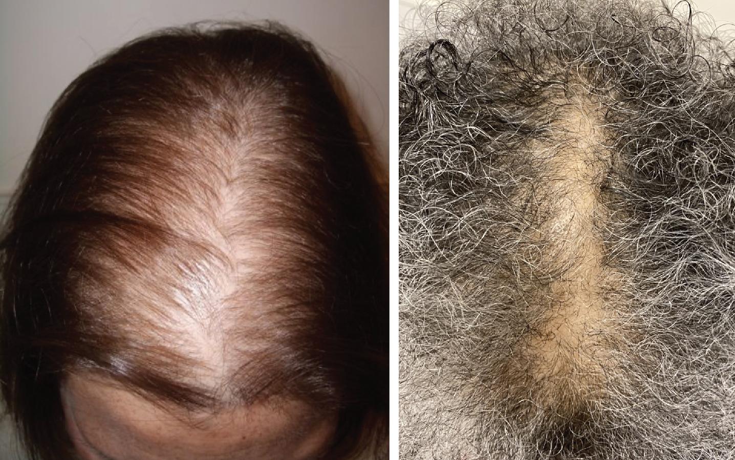 Fig. 1.6, Female Pattern Hair Loss.