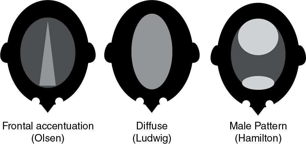 Fig. 1.7, Olsen, Ludwig, and Hamilton Patterns of Hair Loss.