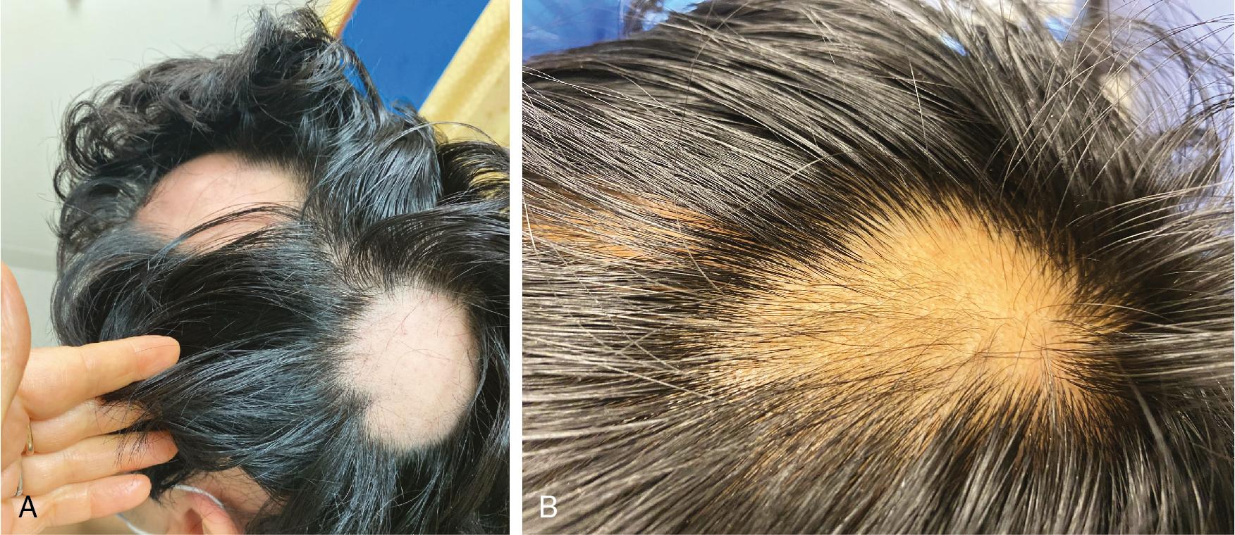 Fig. 1.9, Alopecia Areata.