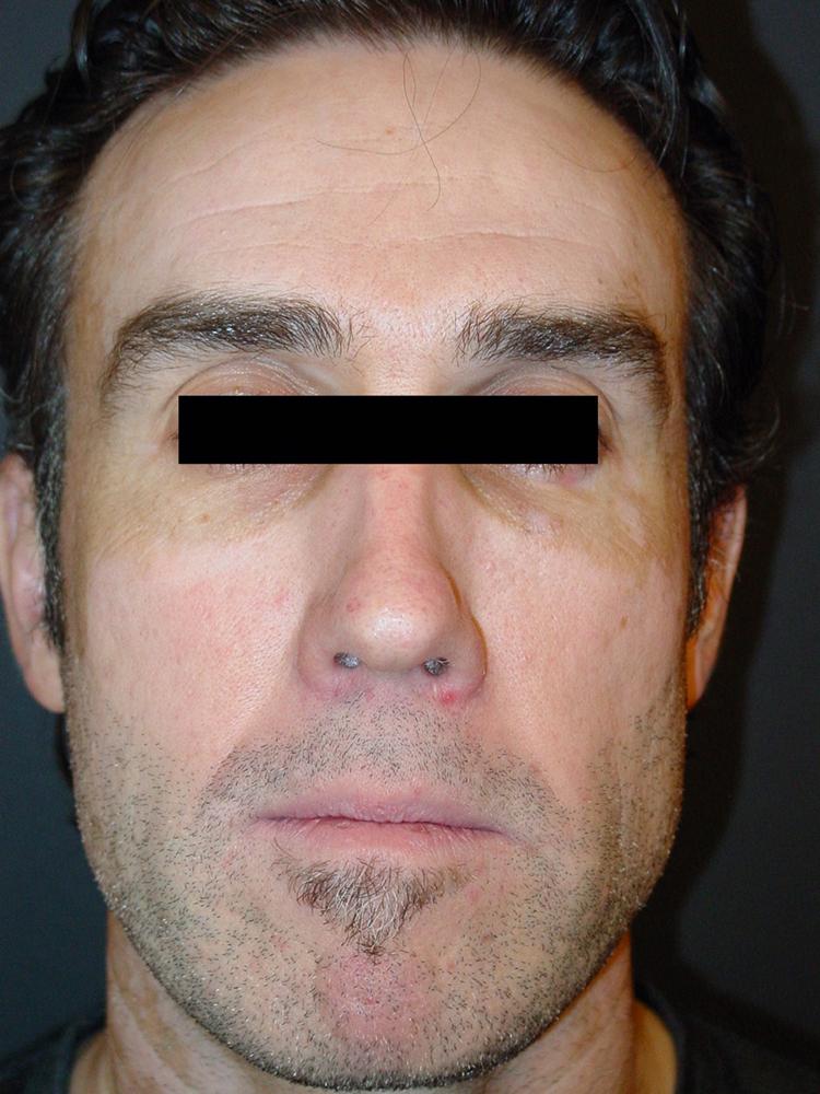 Fig. 5.1, A patient with vitiligo is at risk for Koebnerization.