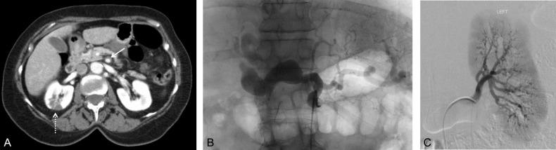 Fig. 41.2, Angiographic findings in patients with polyarteritis nodosa may demonstrate (A) thickening of visceral arteries ( arrow , superior mesenteric artery) and abdominal organ infarcts (dotted arrow, left renal) (computed tomography angiography [axial view]). Conventional angiography may reveal large saccular aneurysms (B, common and right hepatic artery) or multiple microaneurysms (C, left renal artery branches).