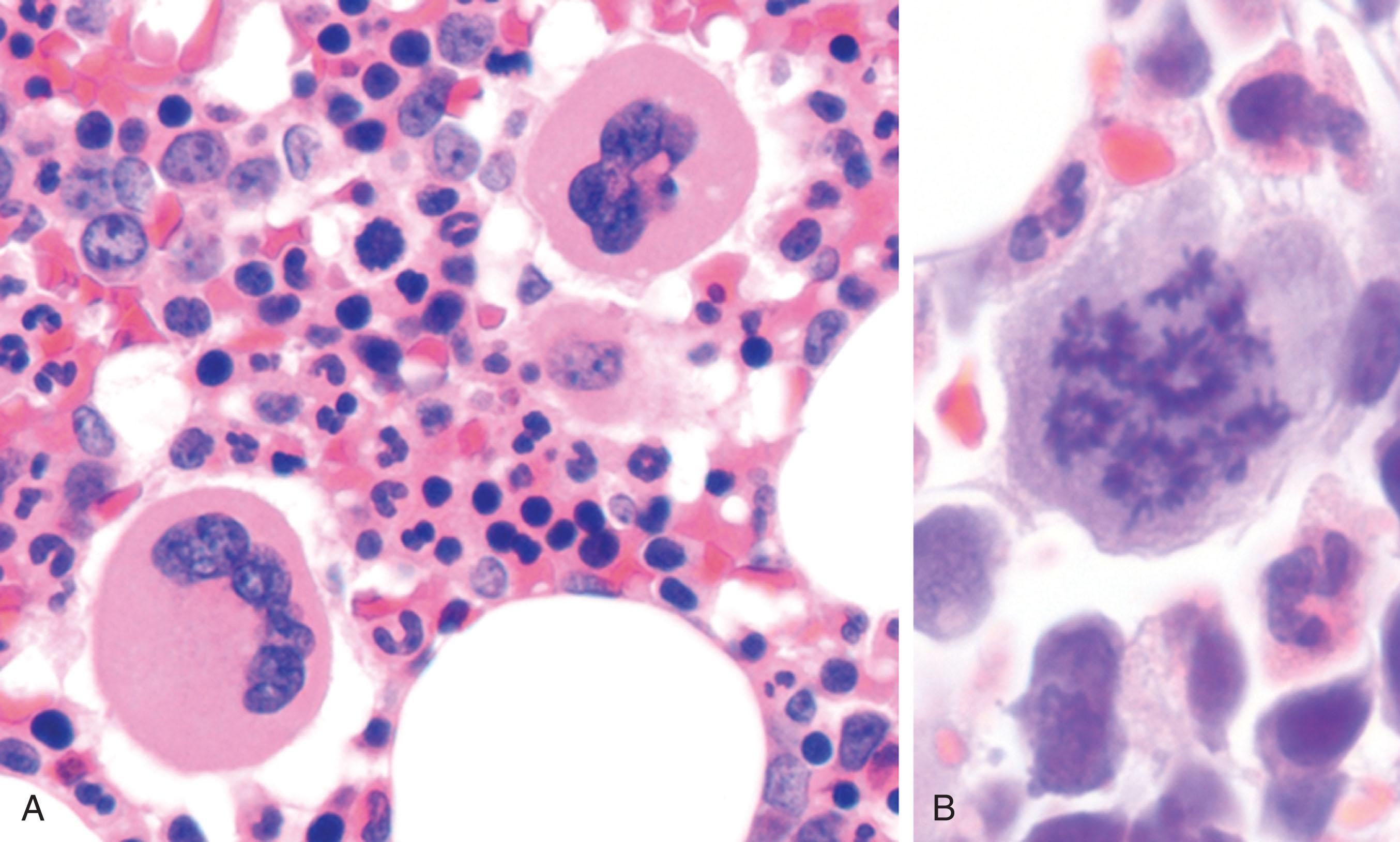 Figure 123.1, POLYPLOID MEGAKARYOCYTES IN THE BONE MARROW.