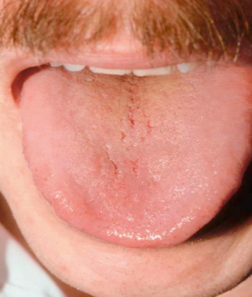 Fig. 4.1, Photograph of the tongue of a patient with pernicious anemia showing smooth papilla and a raw beefy appearance.