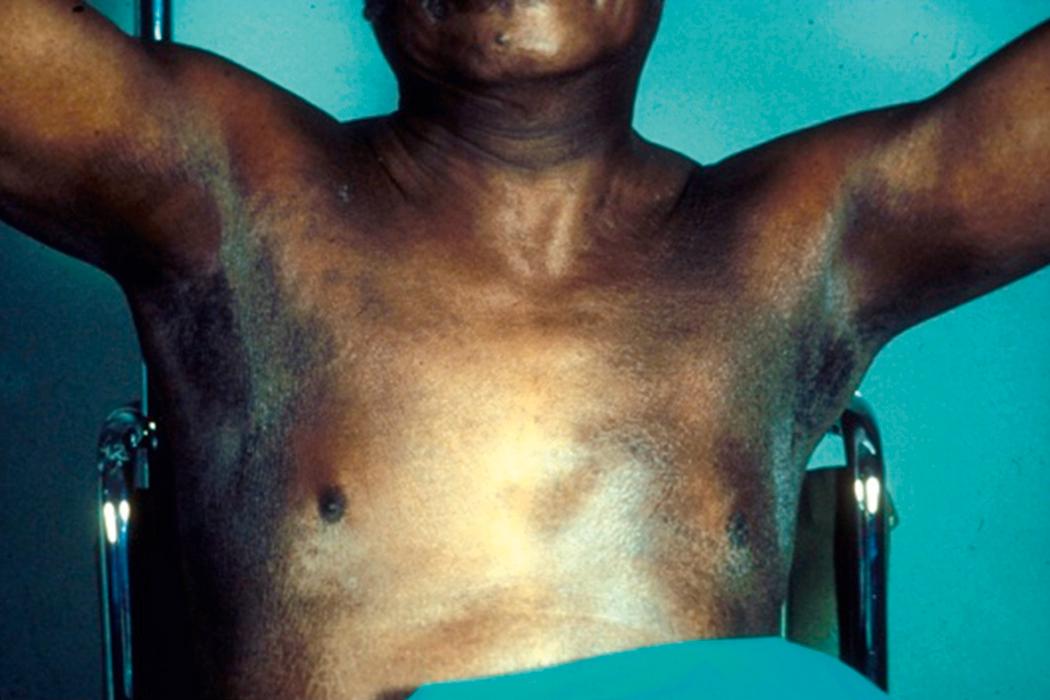 Fig. 4.2, Photograph of hyperpigmentation in the axillary region of a patient with pernicious anemia.